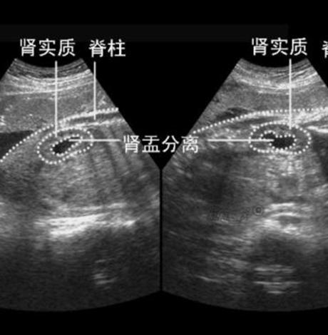 胎儿肾盂分离生下后果 肾盂分离的婴儿出生后