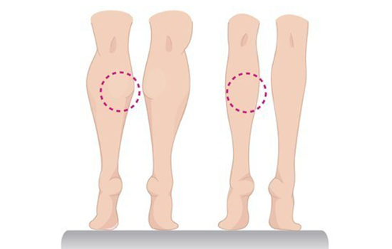 瘦腿针有副作用吗 深扒那些你不知道的瘦腿针副作用