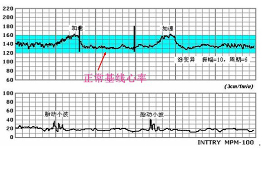 胎心监护图怎么看 胎心监护评分标准是什么