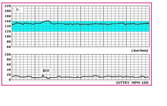 胎心监护图怎么看 胎心监护评分标准是什么