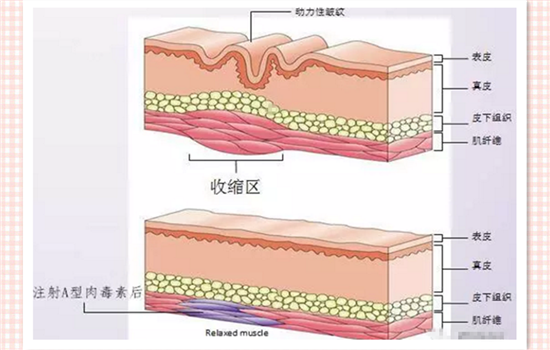 肉毒素的作用原理 瘦肩瘦腿瘦脸针都是什么玩意儿