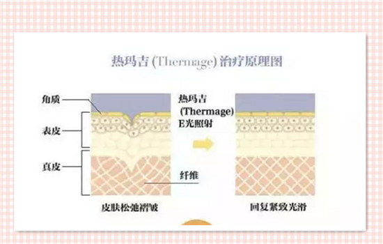 热玛吉效果怎么样 热玛吉美肤重点在于医生和保养