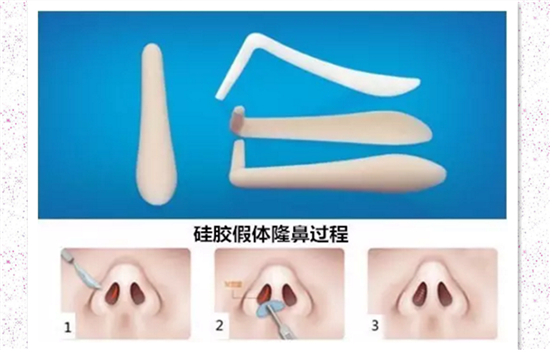 假体隆鼻要打消炎针嘛 硅胶和膨体隆鼻无需额外打消炎针