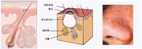 黑头是什么引起的 黑头知识大科普