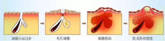 祛痘方法有哪些   怎么祛脸上的痘痘