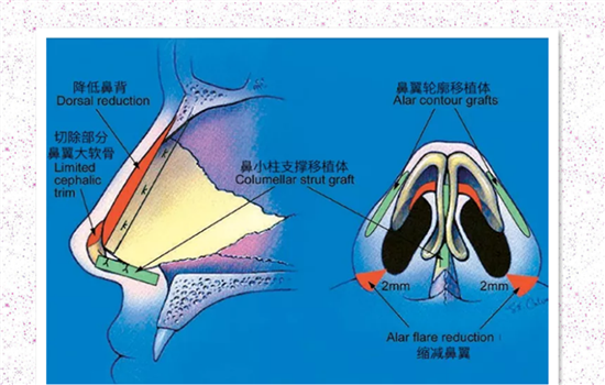 鼻翼缩小安全吗 缩鼻翼术前术后保证这4点更安全