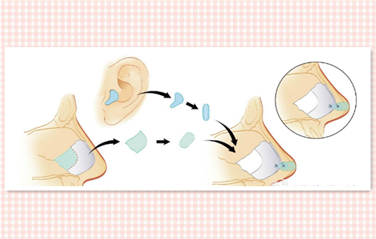 鼻小柱延长用什么材料 可优先选择鼻中隔软骨