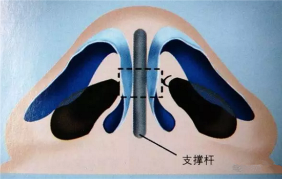 鼻小柱延长方法 千万不能用这种方法打造你的鼻子