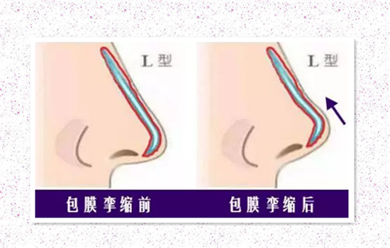 L型假体和柳叶形假体哪个好 一时选错将害自己一生