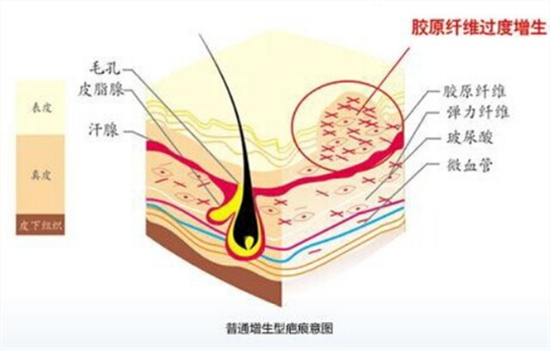 切眉手术疤痕怎么办 强烈推荐解决疤痕的4种好办法