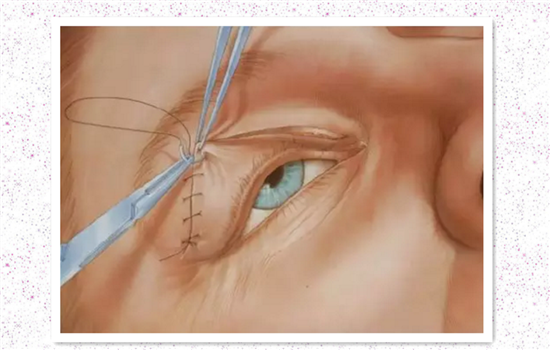 全切双眼皮过程 想做双眼皮手术的姑娘看后惊呆