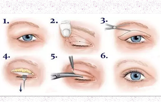 割双眼皮分为几种 强烈推荐的双眼皮术式解析