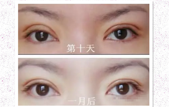 割了双眼皮多久可以种睫毛 眼部化妆美容都应该多注意