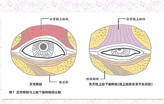 上睑提肌后是永久的吗 正规操作下当然是永久