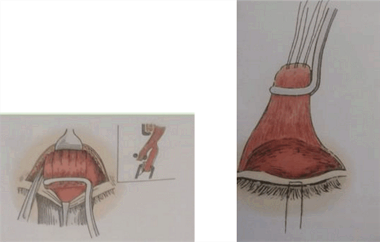 上睑提肌缩短术后悔了 为什么他们都说提肌手术不好
