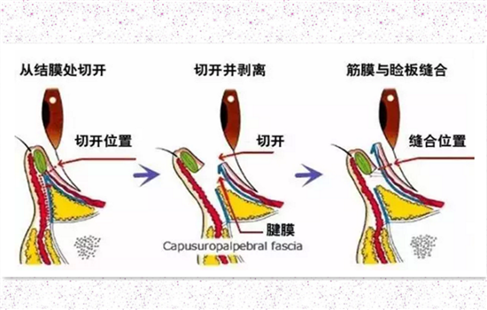 开外眼角和眼睑下至的区别 手术前一定要弄明白的事