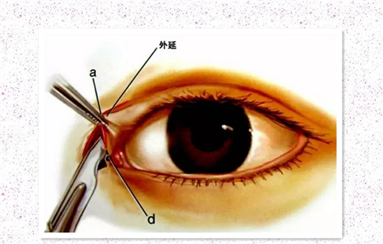 开内眼角好不好 内眦开大术前必须知道的秘密