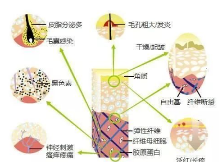 正确的祛痘方法 这些错误祛痘的方法要注意