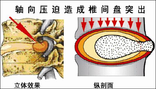 脖子为什么一转就响 脖子一转就嘎巴响的原因