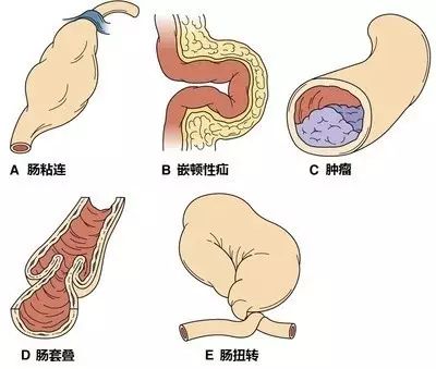 肠梗阻的症状及治疗 这些症状可能是肠梗阻要小心