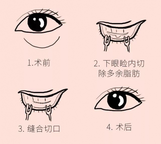 怎么样祛除眼袋 有2个手术方法