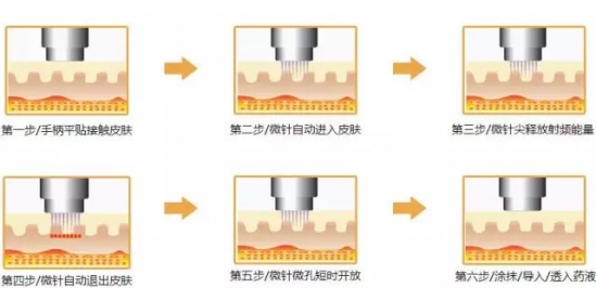 疤怎么去除 黄金射频微针“我在改变,我在做”