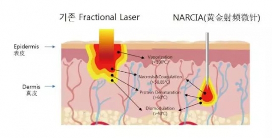 疤怎么去除 黄金射频微针“我在改变,我在做”