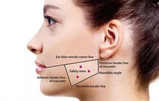 瘦脸针一般打多少单位 一定不能超过剂量否则后果可怕