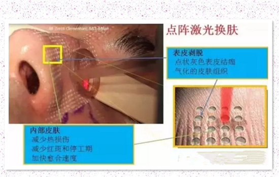 激光祛痘的危害性 你不可不知的三种激光祛痘的危害