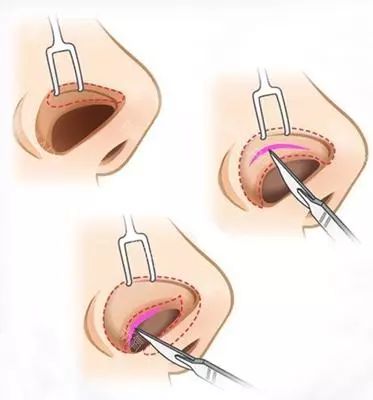 鼻子整形有几种方法 这些内幕你都知道吗