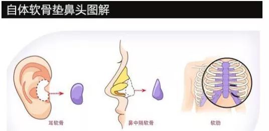 鼻子整形有几种方法 这些内幕你都知道吗