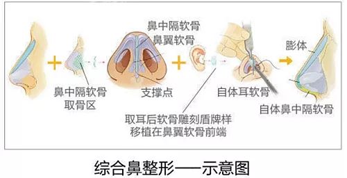 鼻子整形有几种方法 这些内幕你都知道吗