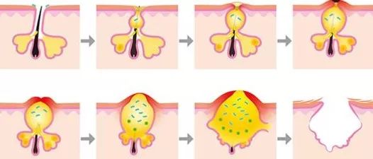 引发痤疮的原因是什么 痤疮的表现又有哪些