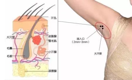 打肉毒素的作用 肉毒素这么厉害你知道吗