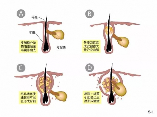 去黑头的产品