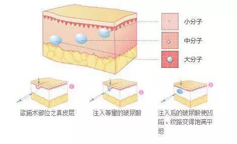 怎么去皱纹最有效