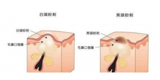 怎么去闭口粉刺