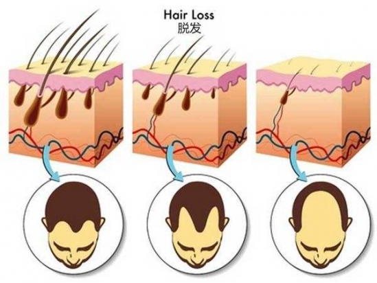 脱发是什么原因引起的 健身多容易脱发吗