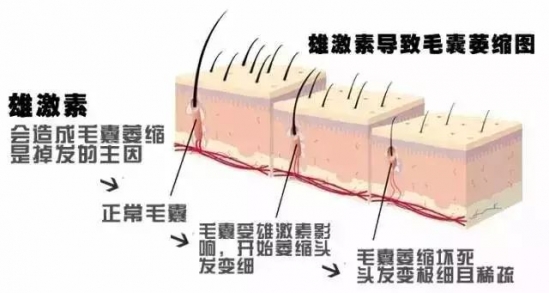 脱发是什么原因引起的 健身多容易脱发吗