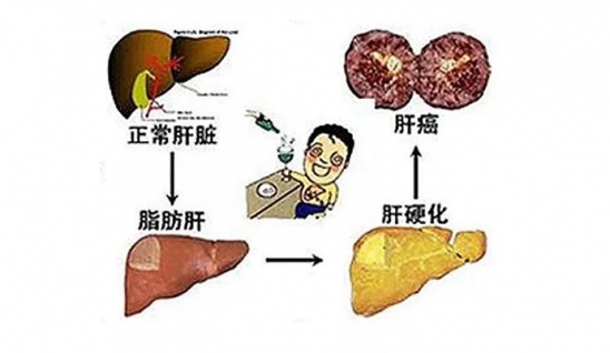 脂肪肝的症状及表现