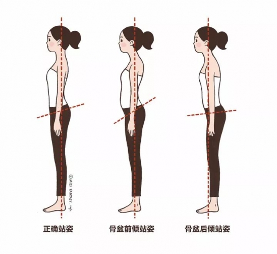 盆骨前倾怎么矫正方法 盆骨前倾矫正方法图解