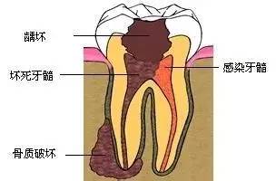 牙疼分几种及症状