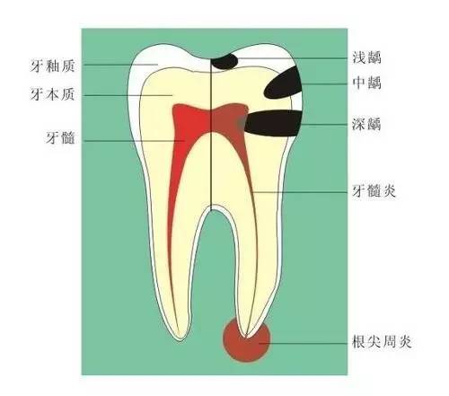 牙疼分几种及症状