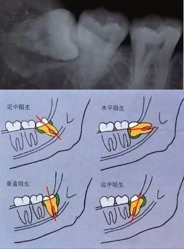 牙疼分几种及症状