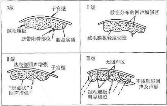 胎盘成熟度分几级 胎盘成熟度有几级