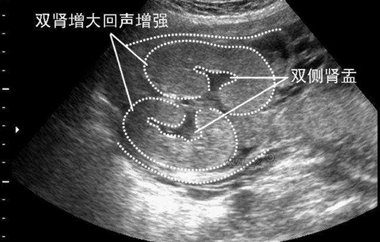 肾盂无分离是什么意思 双肾盂未见明显分离是什么意思