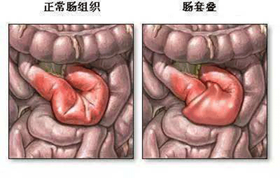 肠套叠的三大典型症状 肠套叠有什么症状