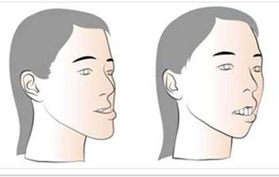 宝宝长牙地包天好不好 宝宝地包天怎么矫正