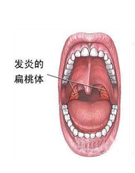 宝宝扁桃体发炎怎么治