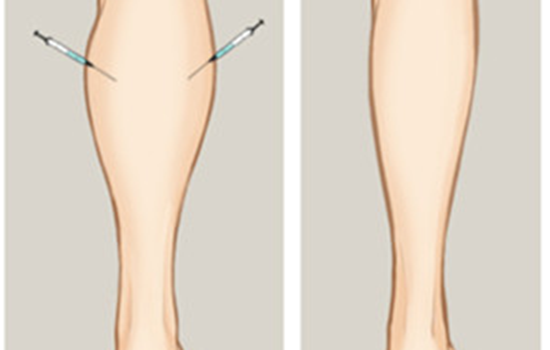瘦腿针多久有效果 瘦腿针几天见效